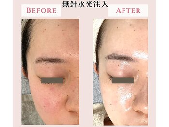 レクラ バイ ドクターエイチ(L'ECLAT by Doctor.H)/無針水光注入”美容液真皮導入”