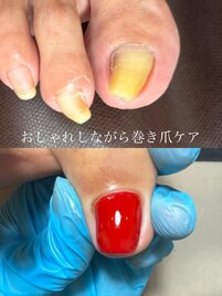 おしゃれしながら巻き爪ケア