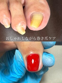ネイルズ バイ ユイ 外苑前(Nails by Yui)/おしゃれしながら巻き爪ケア