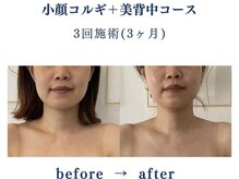 シンシア(sincere)/エラ張りにも効果的