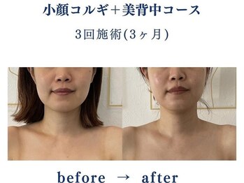 シンシア(sincere)/エラ張りにも効果的