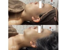 ホッコリ 段原店(HOKKORI)/効果実感No.1BBL光フェイシャル