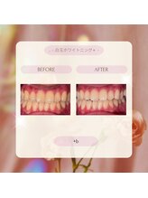 プラスビー 2号店(+b)/ホワイトニングビフォーアフター