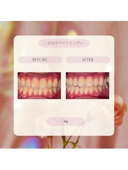 プラスビー 2号店(+b)/ホワイトニングビフォーアフター