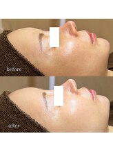 アーネスト 大阪心斎橋店(EARNEST)/韓国式光美容【 美白ハリ弾力 】