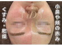 ヴィーダ 渋谷松濤(ViDA)の雰囲気（ハイドラ・プラズマ・ハーブピーリング・EMS・RF/カスタム可能）