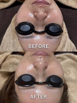 エシャーム(echarme)/Eライト 肌質改善　引き締め