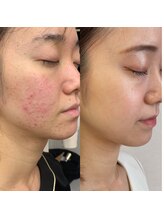 メディカルサロン アヴェニール(Avenir)/リセラで綺麗になりました♪