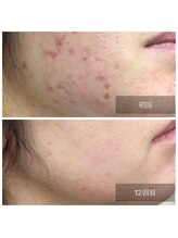 ミドリ(MIDORI)/繰り返すニキビ徹底ケア症例1-3