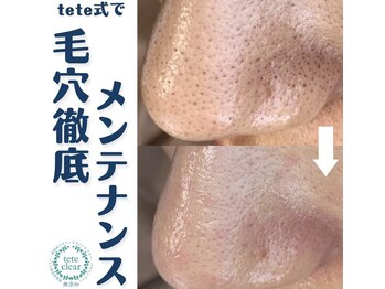 毛穴屋/毛穴洗浄毛穴エクストラクション