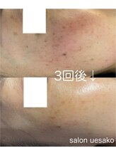 美肌工房 エステサロン上迫/おシミケア大変好評です☆☆