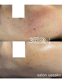 美肌工房 エステサロン上迫/おシミケア大変好評です☆☆