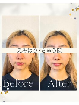 えみはりきゅう院/小顔/リフトアップ/むくみ改善