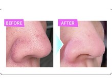 毛穴洗浄で黒ずみ・ザラつきをしっかり落とし、化粧ノリも◎