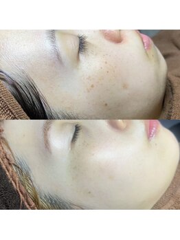 ホワラ 横浜店(Whila)/施術効果１1