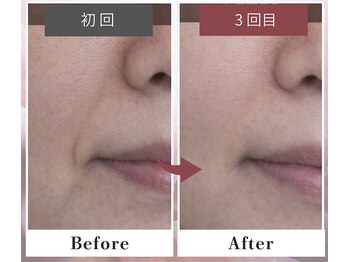 フルリール/【メソポレーションケア】