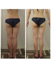 グレイスボディ BiViつくば店(Grace Body)/◆痩身　症例写真
