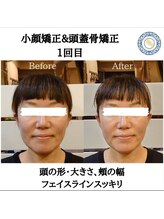 RKY/四角い頭が丸い形へ(1回)(40代)