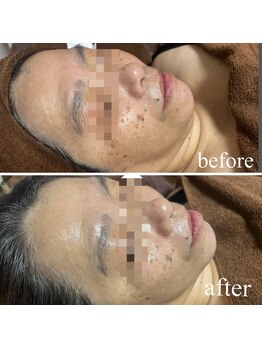 リスール(Re’seule)/ハーブピーリング/before・after