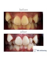 NAホワイトニング 自由が丘店/【before/after】