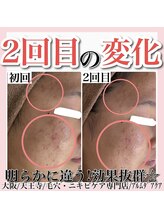 アルムダアクア 天王寺店(Aleumda AQUA)/ハーブピーリング/大阪/天王寺