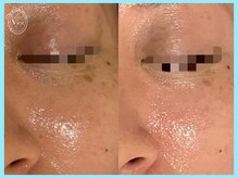 ヴィオール 名古屋栄店(VIOR)/艶やかなお肌に