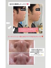 クレール 小山店(CLAIR)/【毛穴洗浄&小顔&赤み改善】