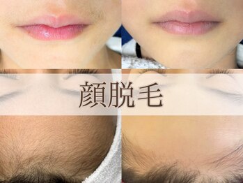 ヴィヴィオドット(vivio.)/顔脱毛