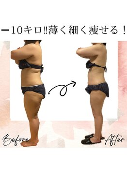 サロン ド ボーテ ラーンジュ 岐阜店(salon de beaut'e L'ange)/ハイパ-ナイフEX2ダイエット痩身