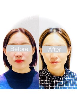 ワカヤマ 小顔(Wakayama)/☆Before・After☆