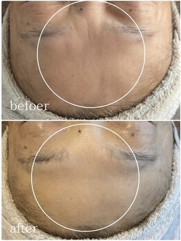 ブリエ 自由が丘(briller)/【生ヒト羊水幹細胞AC導入】