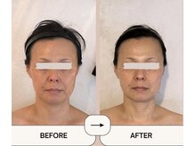 アメアラレ(amearare)/小顔コルギ 90分 6回施術