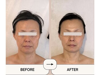 アメアラレ(amearare)/小顔コルギ 90分 6回施術