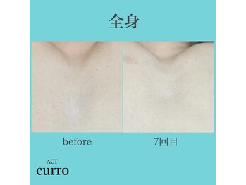 アクト クロ(ACT curro)/【全身(顔・VIO含)】脱毛施術例