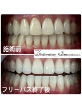 ホワイトニングサロン 京都烏丸店/ホワイトニング施術後