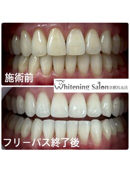 ホワイトニングサロン 京都烏丸店/ホワイトニング施術後