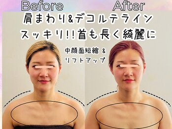 リストアハート(Restore Heart)/デコルテラインスッキり小顔へ