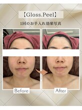ココセンガビューティークリニック 恵比寿(COCO SENGA Beauty-Clinic)/Gloss.Peelお手入れ直後写真