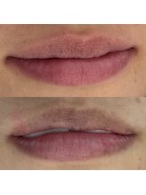 ライム 錦糸町(LIME)/ローマピンク｜黒ずみケア