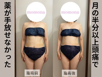 モモナ(Momona)/#肩こり#リンパマッサージ#野並