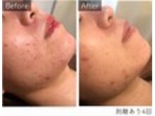 エミルカ 鹿児島店(EMILUCA)/ハーブピーリング　ニキビケア