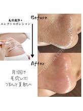 ルミナエステ(LUMINA ESTH)/毛穴／毛穴洗浄／毛穴ケア｜症例