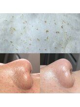 ビューティーネイル(Beauty Nail)/毛穴エクストラクション