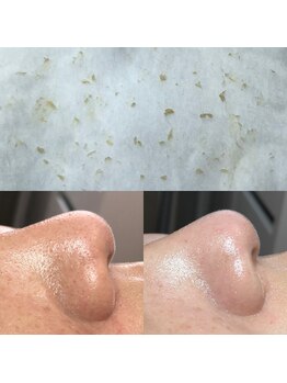 ビューティーネイル(Beauty Nail)/毛穴エクストラクション