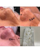 アルルプラス 山科(ARuru+)/【毛穴エクストラクション】