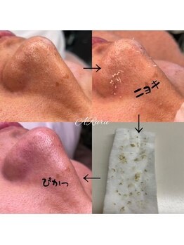 アルルプラス 山科(ARuru+)/【毛穴エクストラクション】