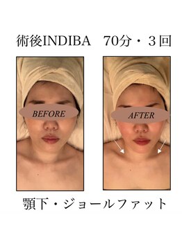 ファミーユ 新宿店/［INDIBAケア】ビフォーアフター