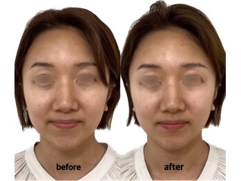 けいのき鍼灸整骨院/美容鍼1回の効果!小顔/小顔矯正