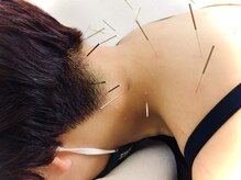 カラダフルピット鍼灸整体院/やさしい鍼施術