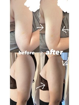 ラ ブリエ(La Briller)/しぶとい二の腕もスッキリと?!